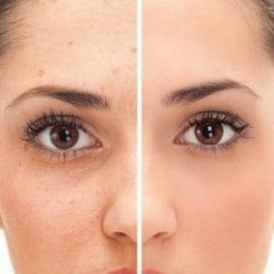 Mamaearth Oil-Free Face Moisturizer for Acne-Prone Skin, (80mL)