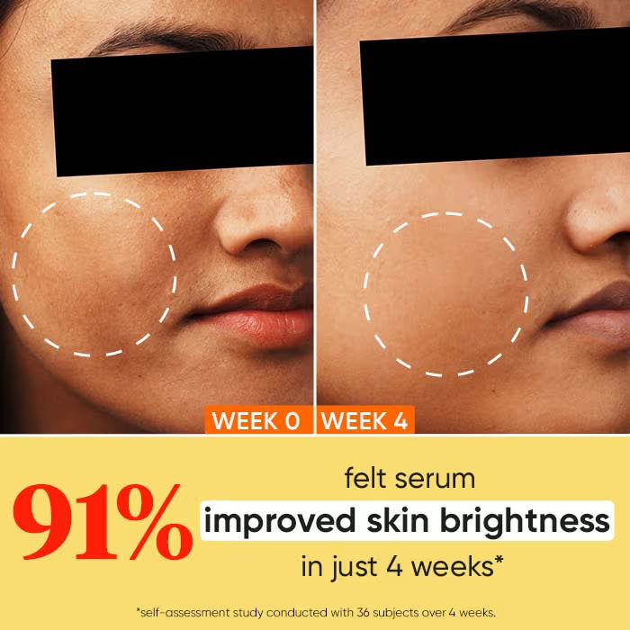 Dot & Key 10% Vitamin C + E Face Serum With 5% Niacinamide, Fights Pigmentation & Dark Spots (30ml)