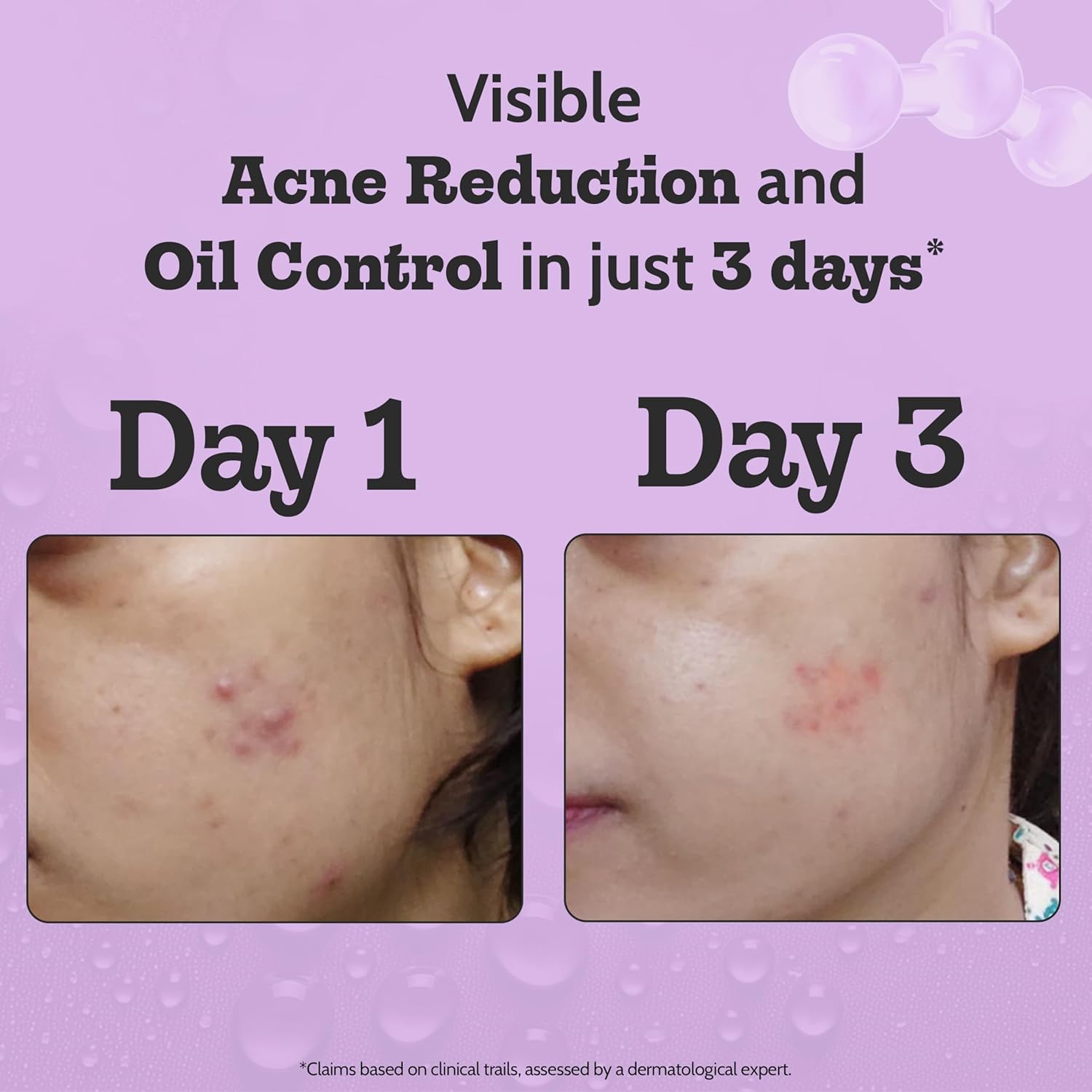 Chemist At Play - 2% Salicylic Acid Acne Control Face Serum (30ML)